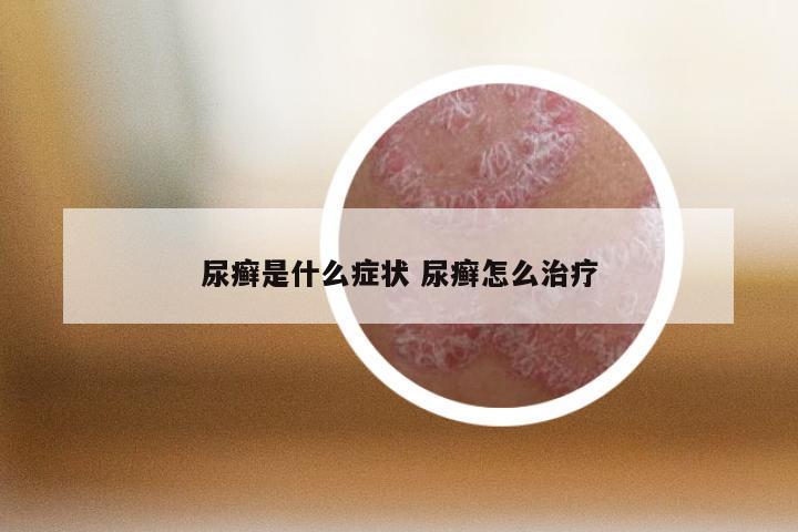 尿癣是什么症状 尿癣怎么治疗