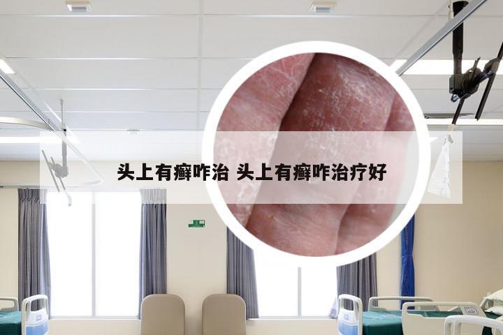 头上有癣咋治 头上有癣咋治疗好