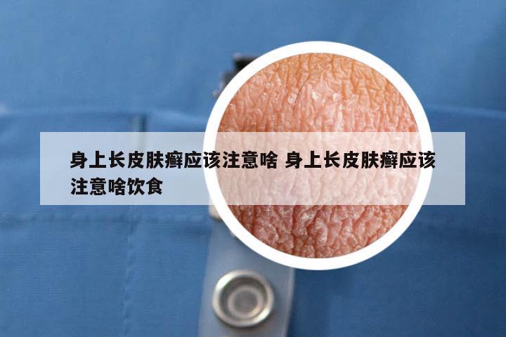 身上长皮肤癣应该注意啥 身上长皮肤癣应该注意啥饮食