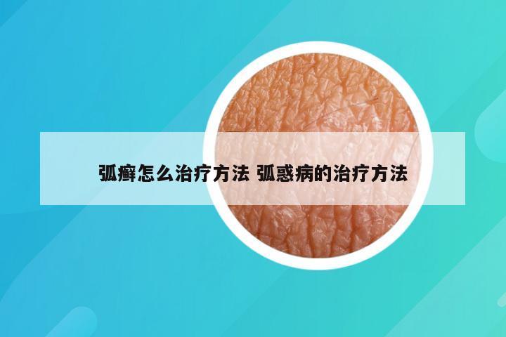 弧癣怎么治疗方法 弧惑病的治疗方法