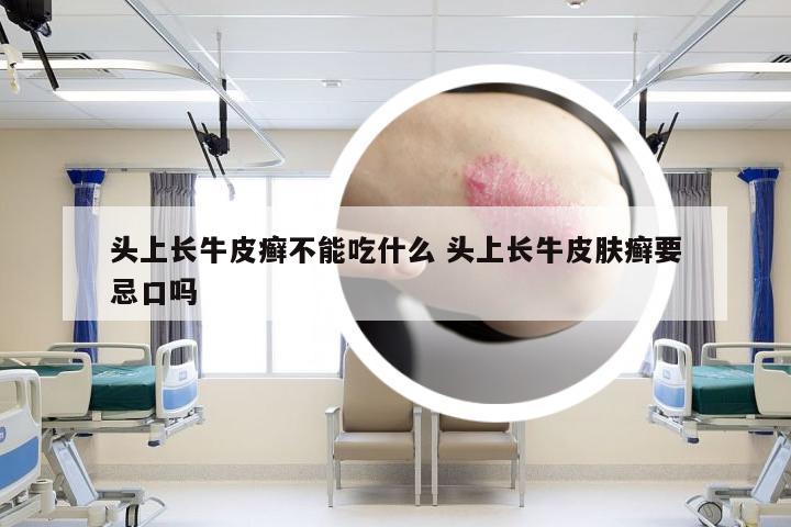头上长牛皮癣不能吃什么 头上长牛皮肤癣要忌口吗