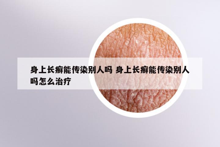 身上长癣能传染别人吗 身上长癣能传染别人吗怎么治疗