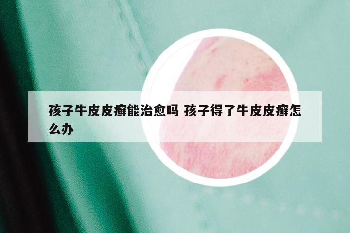 孩子牛皮皮癣能治愈吗 孩子得了牛皮皮癣怎么办