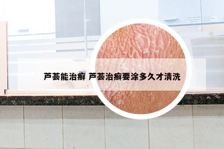 芦荟能治癣 芦荟治癣要涂多久才清洗