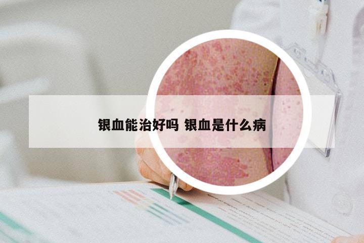 银血能治好吗 银血是什么病