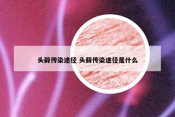 头藓传染途径 头藓传染途径是什么
