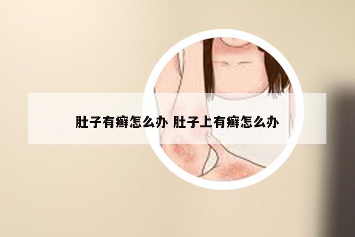 肚子有癣怎么办 肚子上有癣怎么办