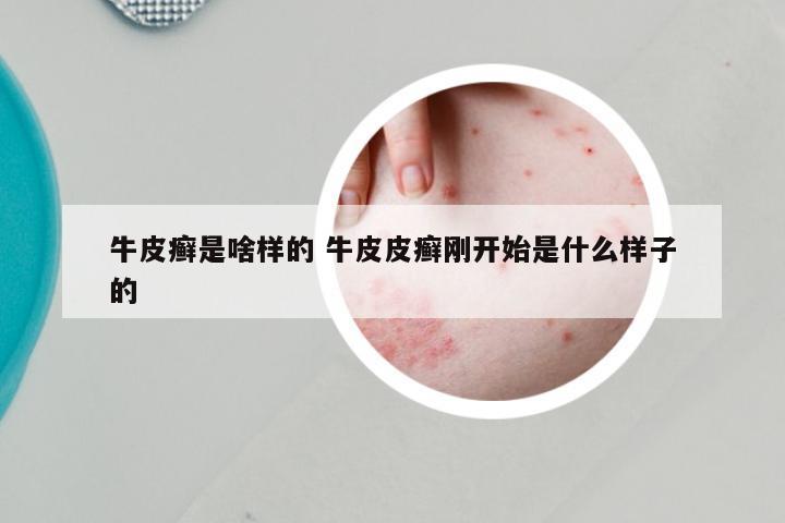 牛皮癣是啥样的 牛皮皮癣刚开始是什么样子的
