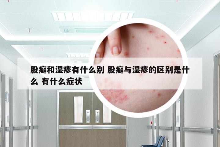 股癣和湿疹有什么别 股癣与湿疹的区别是什么 有什么症状