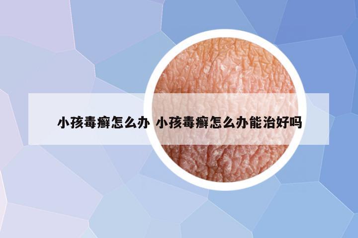 小孩毒癣怎么办 小孩毒癣怎么办能治好吗