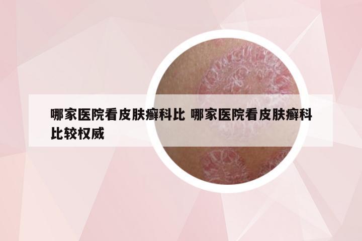 哪家医院看皮肤癣科比 哪家医院看皮肤癣科比较权威