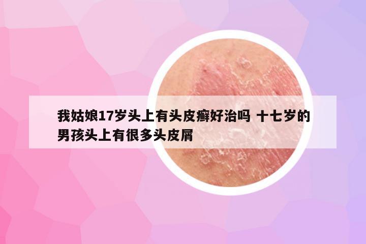 我姑娘17岁头上有头皮癣好治吗 十七岁的男孩头上有很多头皮屑