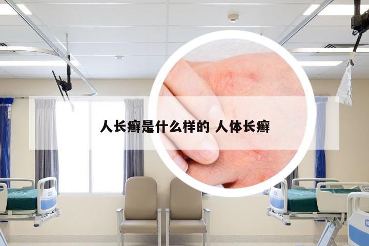人长癣是什么样的 人体长癣