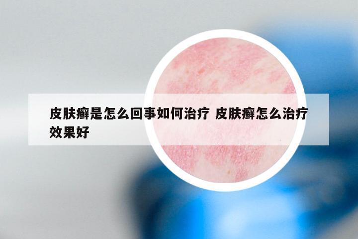 皮肤癣是怎么回事如何治疗 皮肤癣怎么治疗效果好