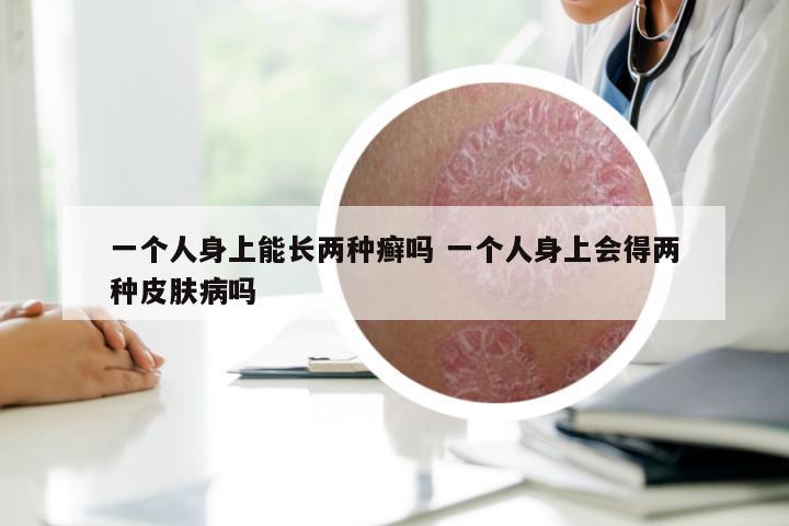 一个人身上能长两种癣吗 一个人身上会得两种皮肤病吗