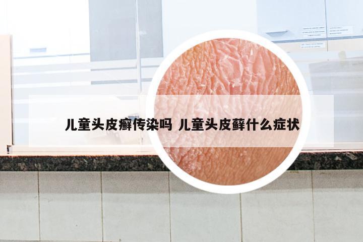 儿童头皮癣传染吗 儿童头皮藓什么症状