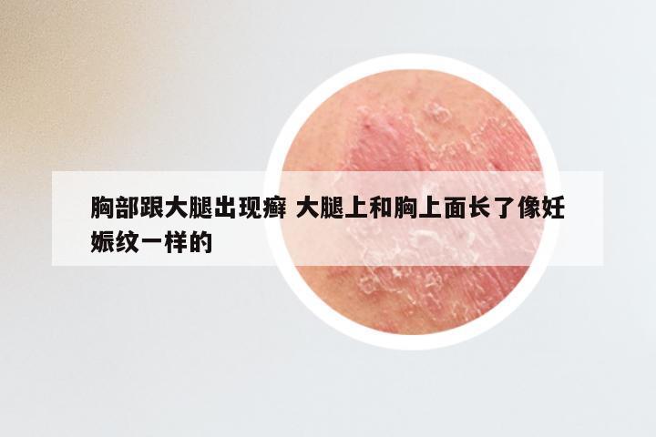 胸部跟大腿出现癣 大腿上和胸上面长了像妊娠纹一样的