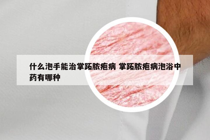 什么泡手能治掌跖脓疱病 掌跖脓疱病泡浴中药有哪种
