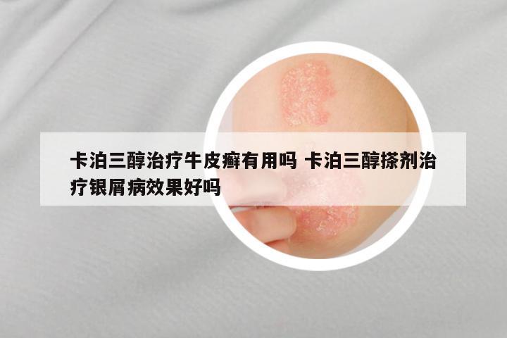 卡泊三醇治疗牛皮癣有用吗 卡泊三醇搽剂治疗银屑病效果好吗
