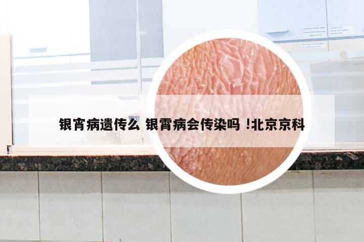 银宵病遗传么 银霄病会传染吗 !北京京科