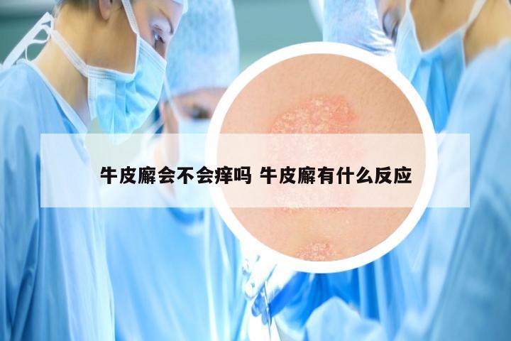 牛皮廨会不会痒吗 牛皮廨有什么反应
