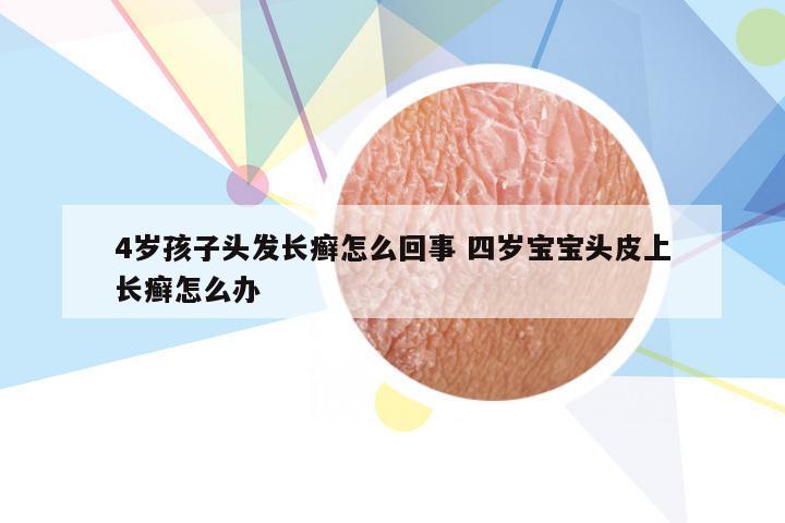 4岁孩子头发长癣怎么回事 四岁宝宝头皮上长癣怎么办