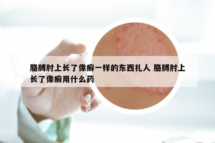 胳膊肘上长了像癣一样的东西扎人 胳膊肘上长了像癣用什么药