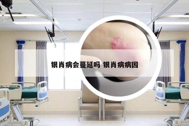 银肖病会蔓延吗 银肖病病因