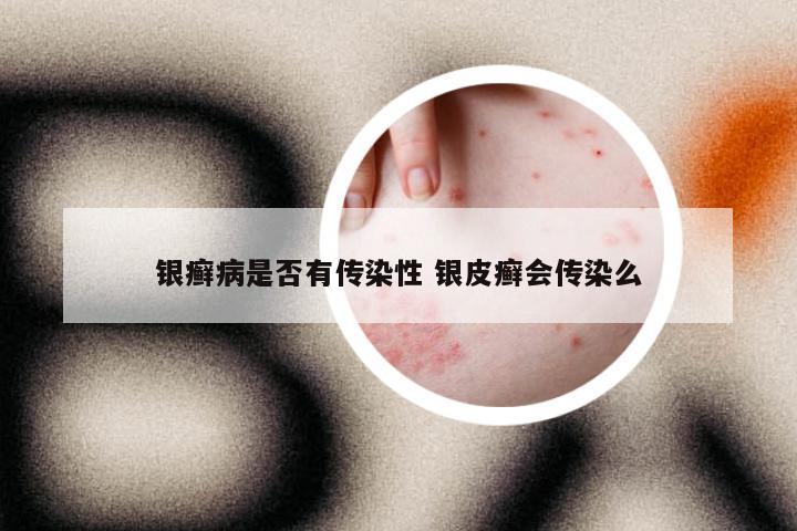 银癣病是否有传染性 银皮癣会传染么
