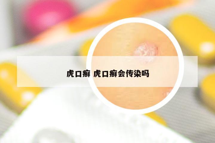 虎口癣 虎口癣会传染吗