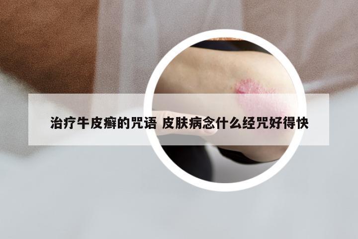 治疗牛皮癣的咒语 皮肤病念什么经咒好得快