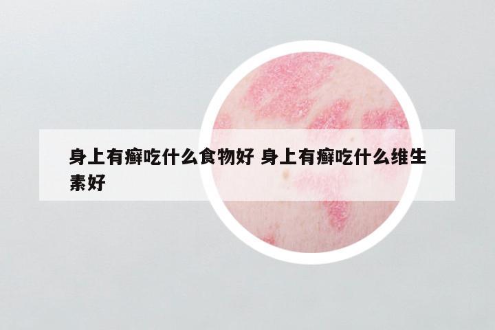 身上有癣吃什么食物好 身上有癣吃什么维生素好