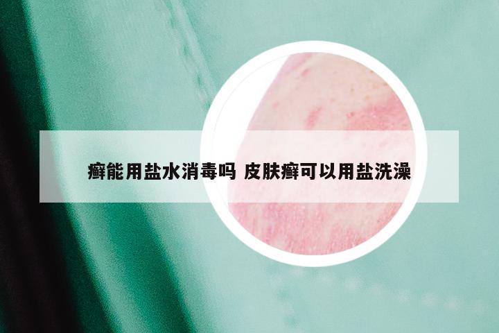 癣能用盐水消毒吗 皮肤癣可以用盐洗澡