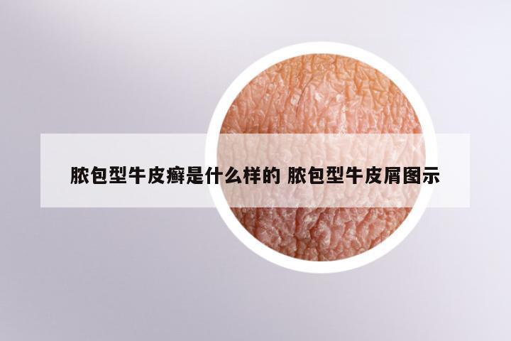 脓包型牛皮癣是什么样的 脓包型牛皮屑图示