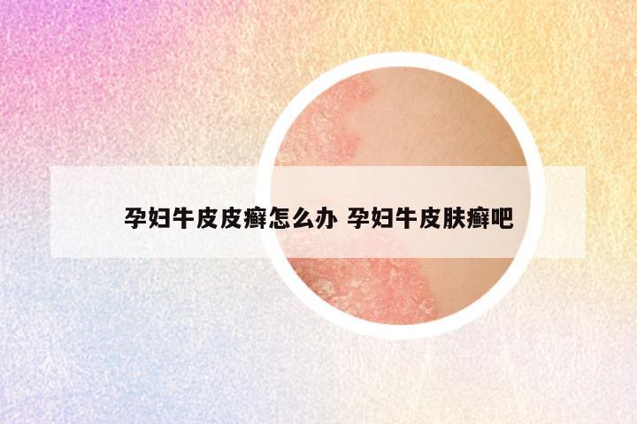 孕妇牛皮皮癣怎么办 孕妇牛皮肤癣吧