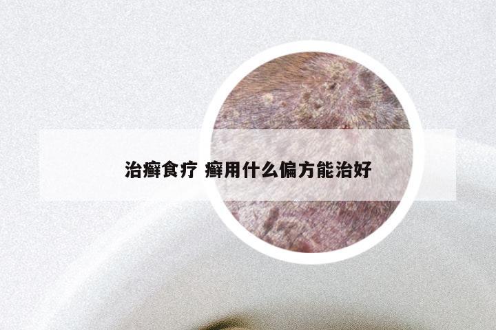 治癣食疗 癣用什么偏方能治好