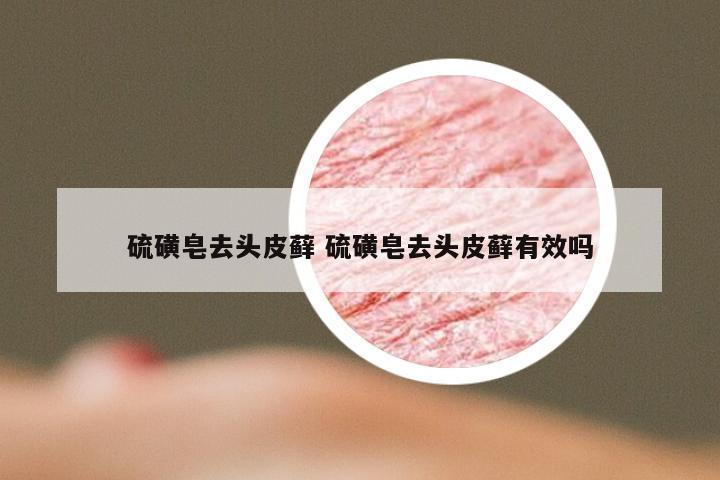 硫磺皂去头皮藓 硫磺皂去头皮藓有效吗