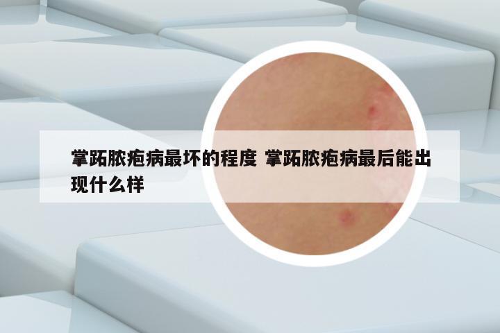 掌跖脓疱病最坏的程度 掌跖脓疱病最后能出现什么样