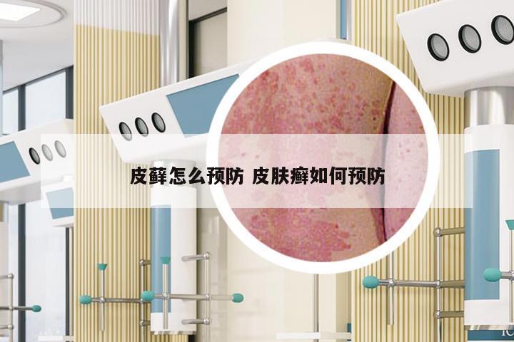 皮藓怎么预防 皮肤癣如何预防