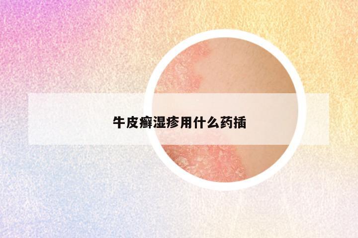 牛皮癣湿疹用什么药插