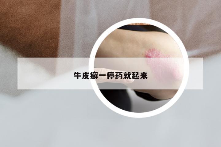 牛皮癣一停药就起来