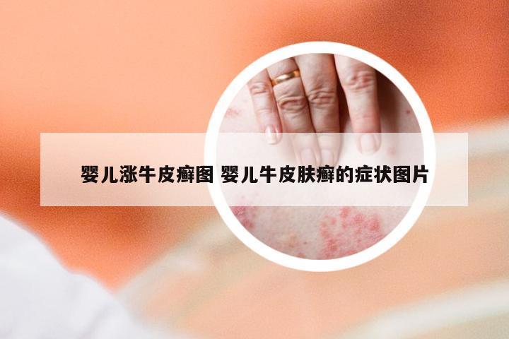 婴儿涨牛皮癣图 婴儿牛皮肤癣的症状图片