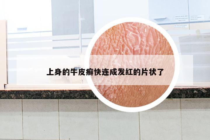 上身的牛皮癣快连成发红的片状了