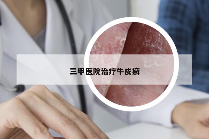 三甲医院治疗牛皮癣