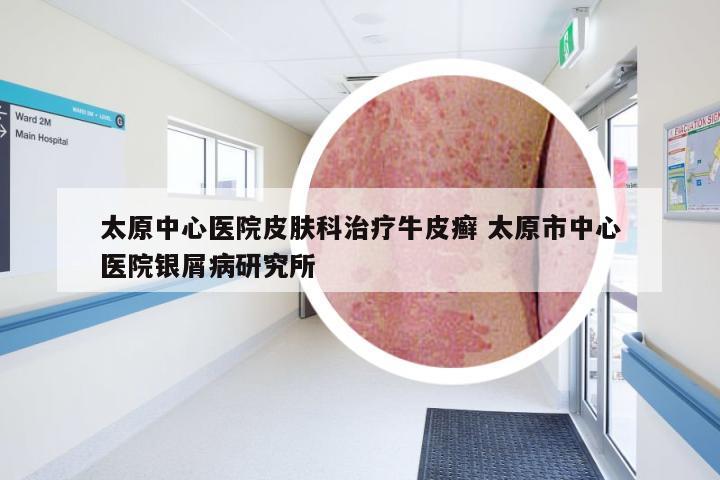 太原中心医院皮肤科治疗牛皮癣 太原市中心医院银屑病研究所