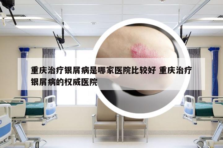 重庆治疗银屑病是哪家医院比较好 重庆治疗银屑病的权威医院