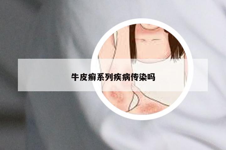 牛皮癣系列疾病传染吗