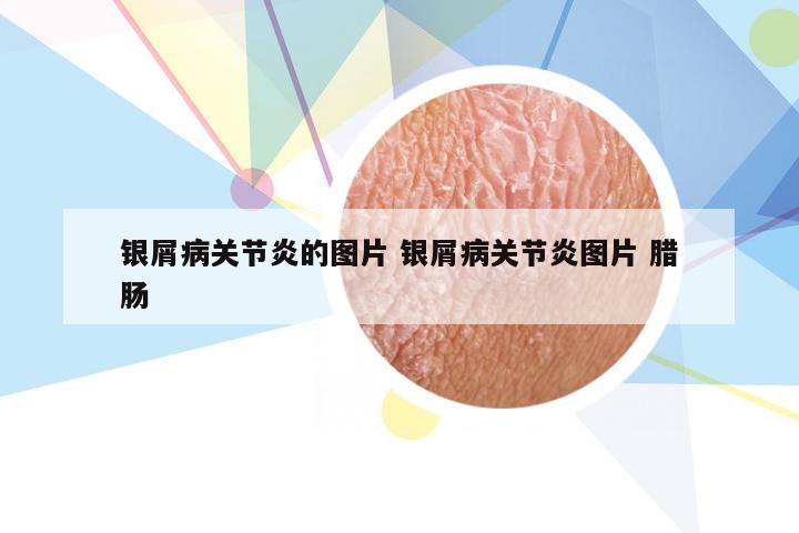 银屑病关节炎的图片 银屑病关节炎图片 腊肠