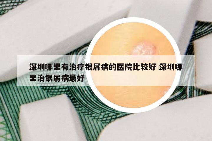 深圳哪里有治疗银屑病的医院比较好 深圳哪里治银屑病最好