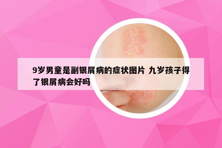 9岁男童是副银屑病的症状图片 九岁孩子得了银屑病会好吗